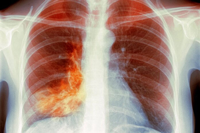 q&a:-‘white-lung’-pneumonia-–-what-you-need-to-know